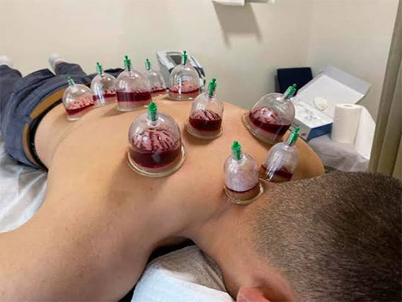 MedyHealth - top hijama Therapy at Home in gurgaon delhi ncr