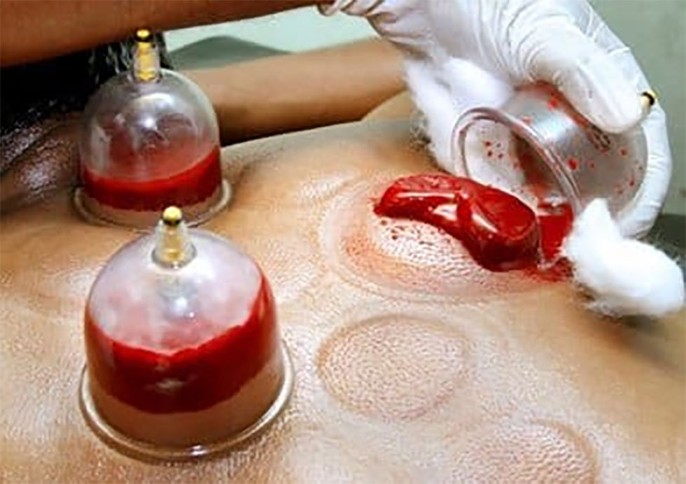 MedyHealth - hijama Therapy for Better Recovery in gurgaon delhi ncr
