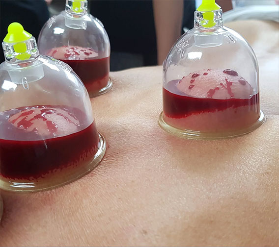 MedyHealth - Wet Cupping Hijama at Home near me in Gurgaon Dlehi NCR
